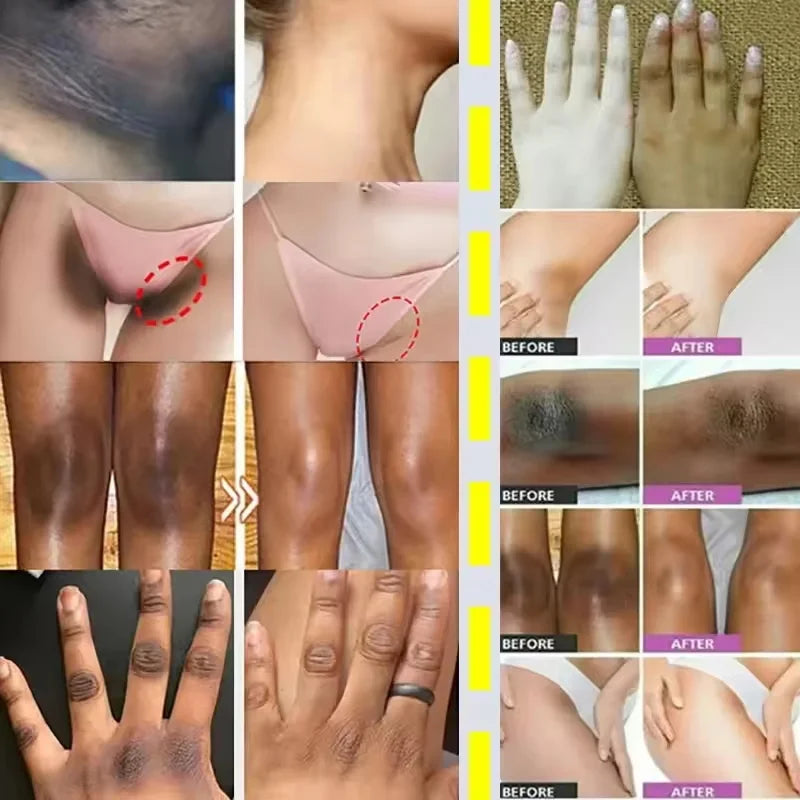 Whitening Cream Private Parts Underarm Butt Knee Whiten Inner Thigh Intimate Parts Dark Remove Melanin Woman Brighten Skin Care