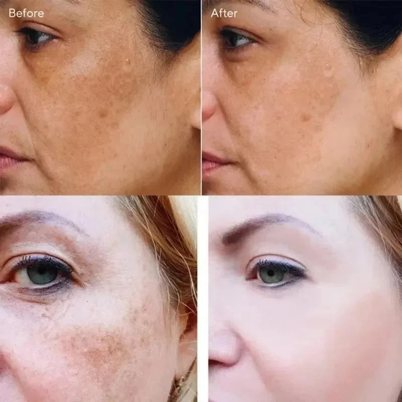 Crema blanqueadora potente que elimina manchas