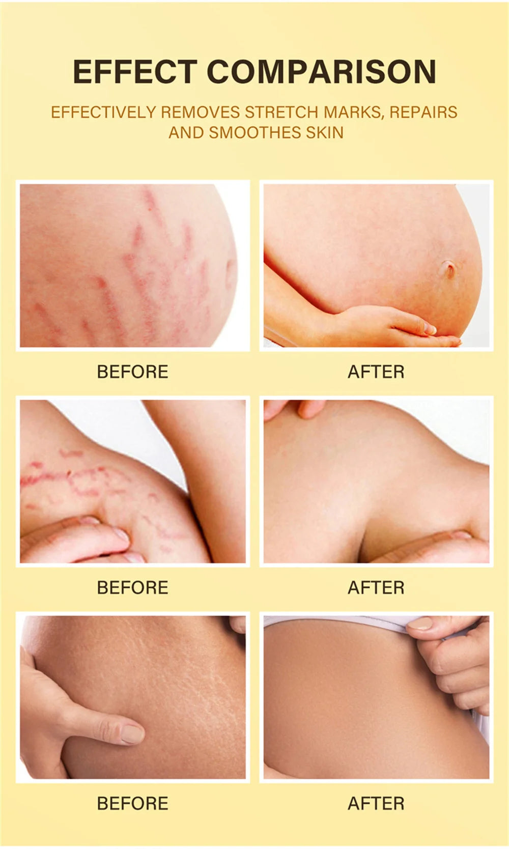 Stretch Mark Removal Oil Removes Postpartum Pregnant Women Scar Repair Obesity Stretch Mark Anti-Aging Firming Serum Skin Care